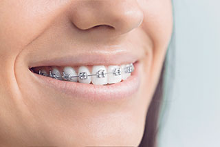 Metal Braces